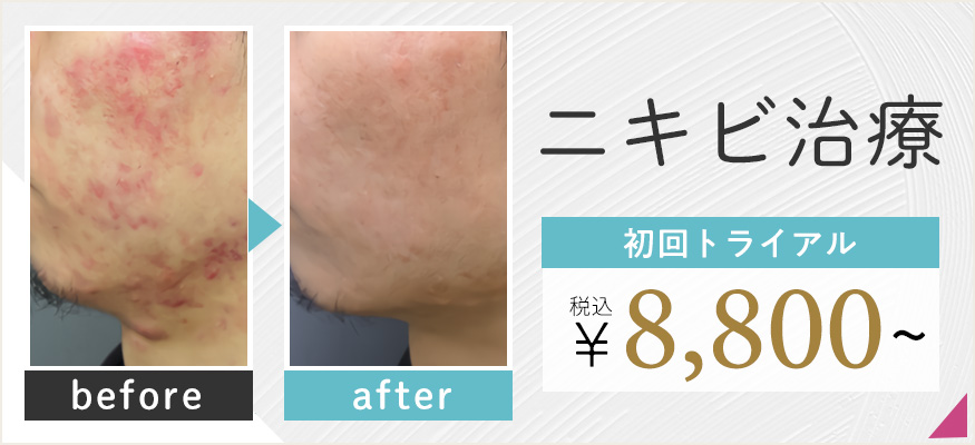 重症のニキビ治療、ニキビ跡の治療